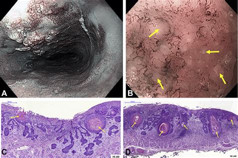 Keratin Pearls In Magnifying Endoscopy Of Superficial Esophageal