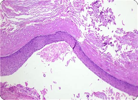 Histology Of An Odontogenic Keratocyst Download Scientific Diagram