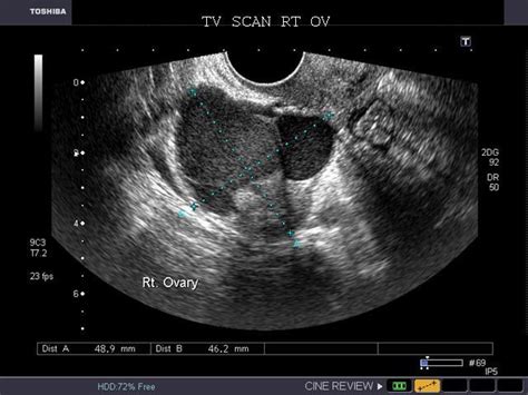 Normal Ovary Ultrasound Health Medicine And Anatomy Reference