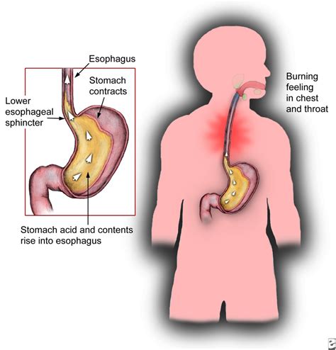 Refluxul gastroesofagian care sunt cauzele şi cum se manifestă