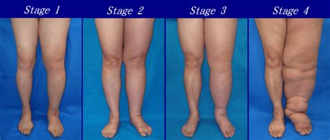 Difference Between Lipedema And Lymphedema Compare The Difference
