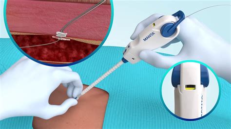 Manta Vascular Closure Device Animation Youtube