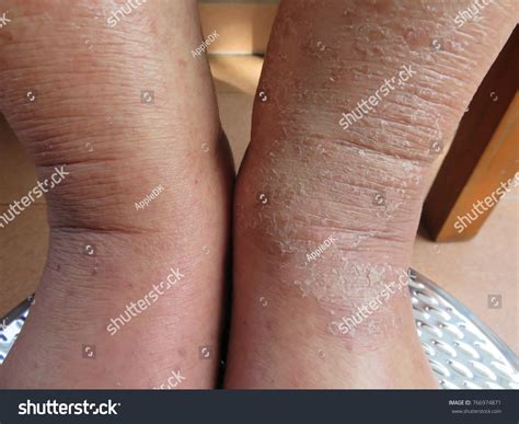 Problem Dry Skin Peeling On Legs Stock Photo 766974871 Shutterstock