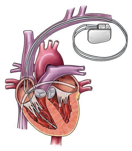 Sometimes after a shock is delivered, the heart may beat too slowly. Implantable Cardioverter Defibrillator (ICD) | Pacemaker ...