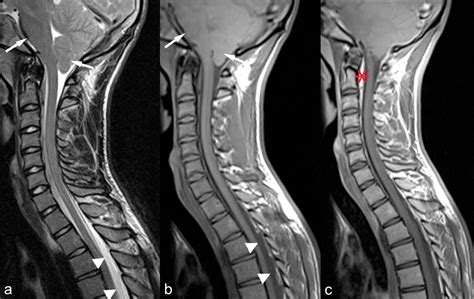 Intractable Headache After Lumbar Puncture The Bmj