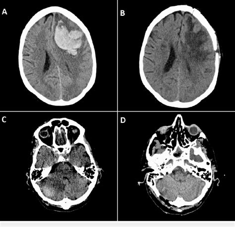 Computed Tomography Ct Scans Of The Patients Brain A Left Frontal