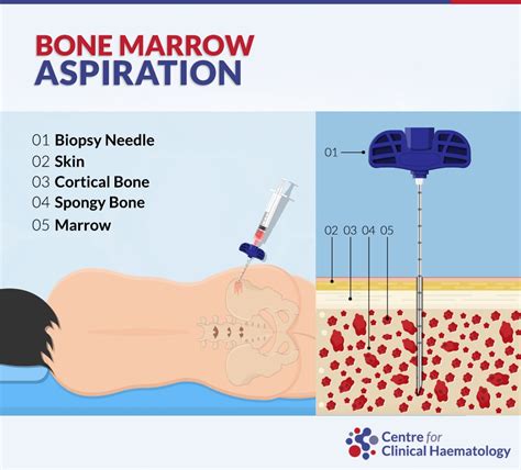 Bone Marrow Biopsy And Bone Marrow Aspiration Cfch Centre For
