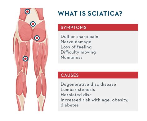 What Is Sciatica Symptoms And Causes And How To Deal With It By Md Thordis Berger