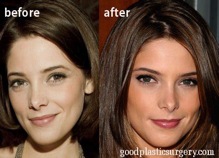 13.09.2021 · donny osmond has detailed his health woes, after he was unable to move following back and neck surgery in 2019. Kate Beckinsale Plastic Surgery Before And After: 02/16/12