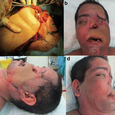 Extensive crush degloving injury of the face with composite loss of ...