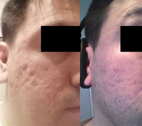 Phenolacidpeelforbadacnescars32yroldmale Scar Treatments