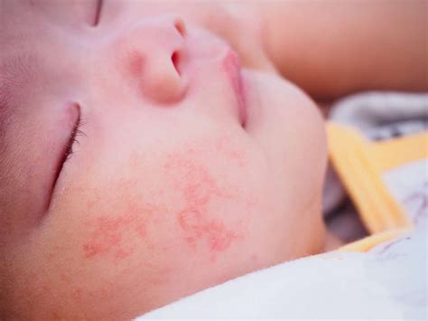 Introducing allergenic foods including eggs, tree nuts, fish, milk, peanut, soy, shellfish and wheat may cause a skin rash to appear. Allergic reaction in baby: Treatment and pictures