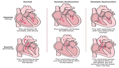 Heart Failure Cardiomyopathies Exam Flashcards Quizlet