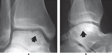 17: Osteonecrosis and Osteochondrosis | Musculoskeletal Key