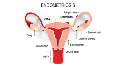 endometriosis the 4 stages and treatment options