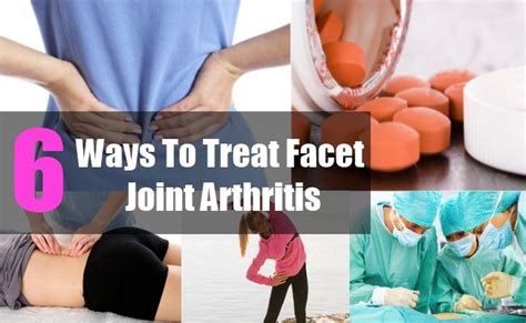 6 Ways To Treat Facet Joint Arthritis Arthritis