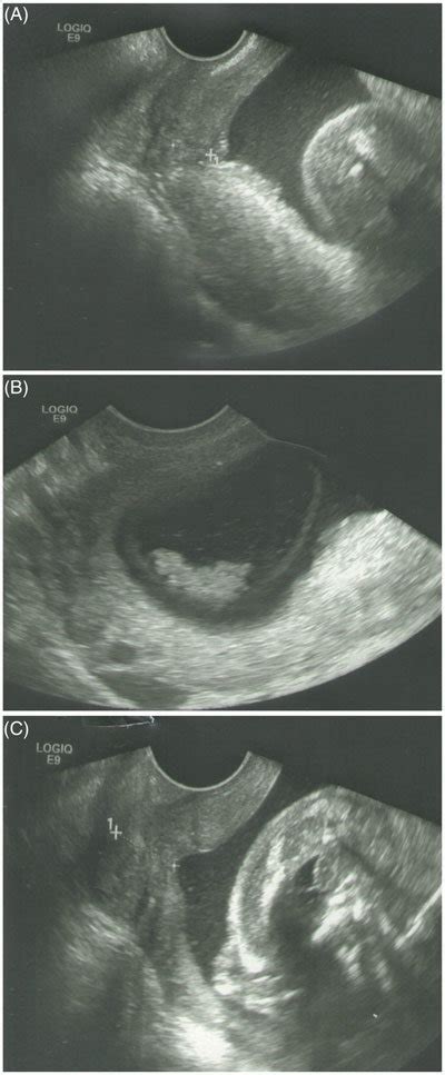 Ultrasound Appearance Of An Amniotic Fluid Sludge Transvaginal