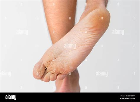 Peeling And Cracked Footfungal Infection Or Athletes Foot Dry Skin