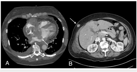 Ct Abdomen And Pelvis With Iv Contrast Left Panel Interatrial Septal