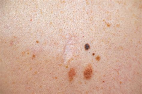 Benign And Precancerous Lesions Dermatology Australasia
