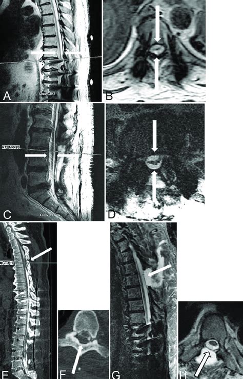 Case 1 Sagittal A And C And Axial B And D Mri After First