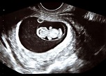9 Weeks Pregnant Ultrasound