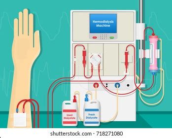 Fresenius 2008t dialysis machine diagram. Dialysis Images, Stock Photos & Vectors | Shutterstock