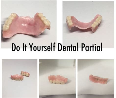 Do It Yourself Denture Kit Make Your Own Temporary Etsy Partial Dentures Dental Impressions