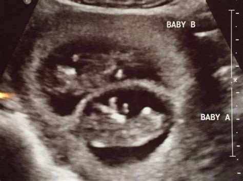10 Week Ultrasound This Morning Im Having Twins Babybumps