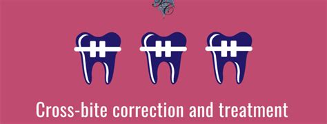 Cross Bite Correction And Treatment Tim Chauvin Dental Lafayette La