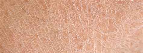 Diabetes Dry Skin On Legs Help Health