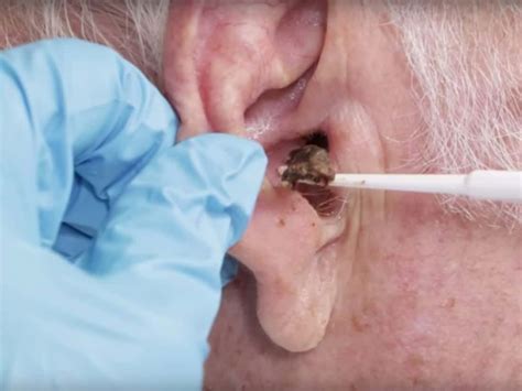 Ear Wax Causes Symptoms And Treatment