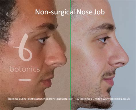 We did not find results for: Non Surgical Nose Job for Men in London - UK * 5 STAR Rated*