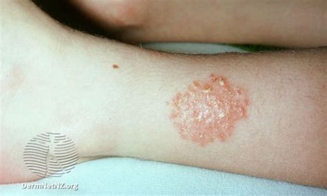 Discoid Eczema Nhs Inform