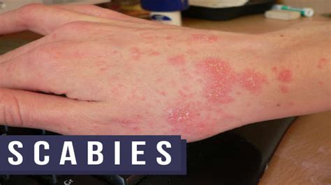 Scabies Causes Transmission Symptoms Diagnosis Treatment And