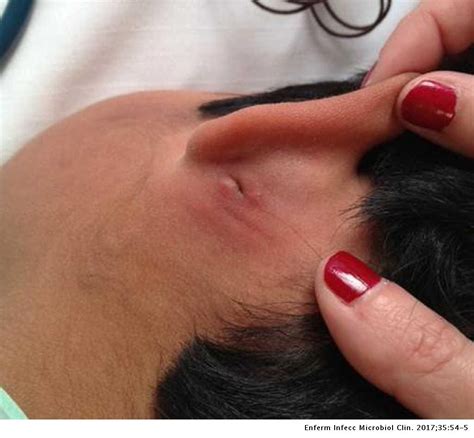 Surgical treatment of fistula in ano. Fever, parotid swelling, otorrhea and retroauricular ...