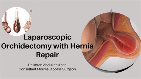 Laparoscopic Orchidectomy With TAPP Laparoscopic Inguinal Hernia