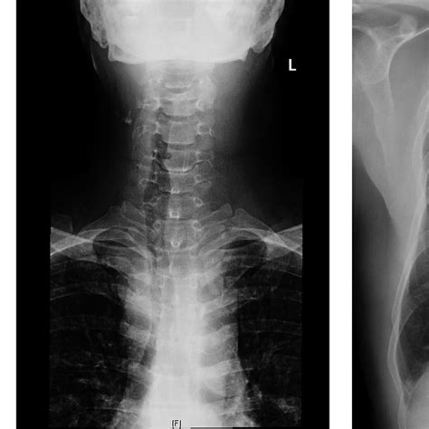X‐ray Findings A Soft Tissue Swelling On Lateral Neck X‐ray B Ap