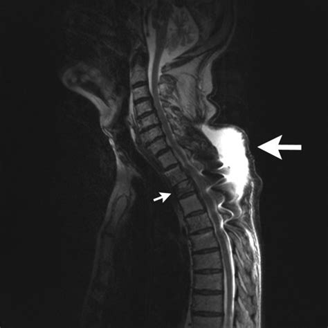 Mri Of The Thoracic Spine T2 Weighted Sagittal Reconstruction The