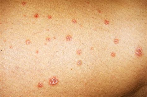 Home Remedies For Guttate Psoriasis