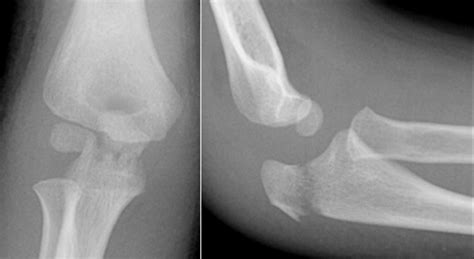 Complications After Pinning Of Supracondylar Distal Humerus Fractures
