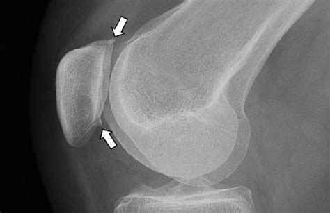 The Knee Resource Osteoarthritis Oa