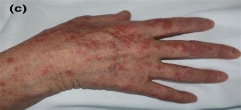 Erythema Multiforme In The Acral Area Of A Confirmed Covid 19 Patient