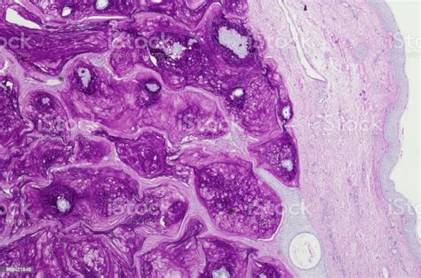 Primary Mucinous Eccrine Adenocarcinoma Of Skin Pas Stain Stock Photo