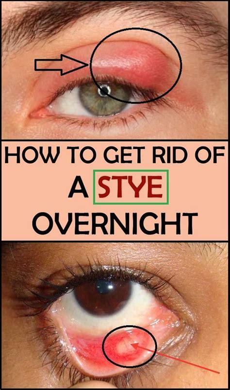 How To Get Rid Of A Stye Overnight V Remedies Otosection