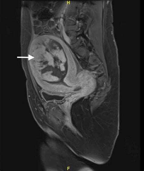 Cureus The Rule Of Ultrasonography In The Management Of Retained Placenta