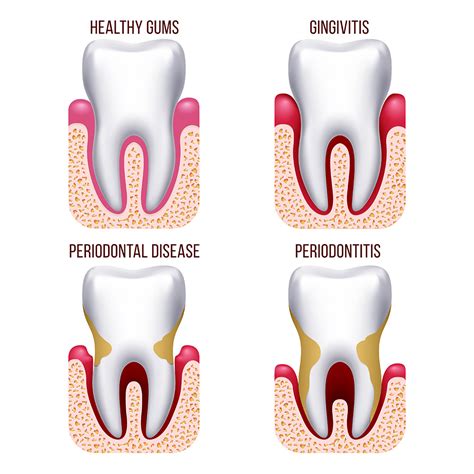Causes And Concerns Of Bleeding Gums Bethany Stewart Dentistry