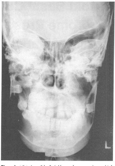 Figure 1 From Nevoid Basal Cell Carcinoma Syndrome Presenting As