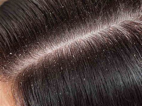 What Is Hair Dandruff Causes And Remedies Setsuko Ny Hair Salon