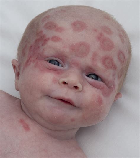A Neonate With A Rash The Bmj